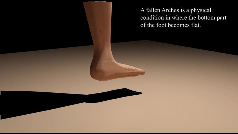 Fallen Arch / Flat muscle